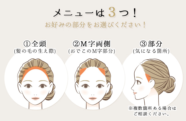 ヘアラインのアートメイク